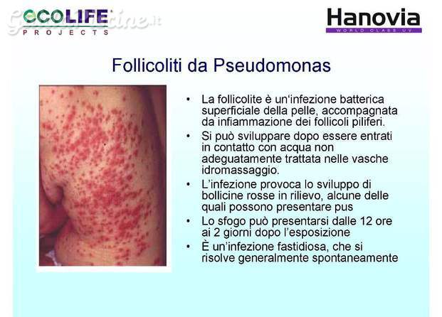 Follicoliti da Pseudomonas